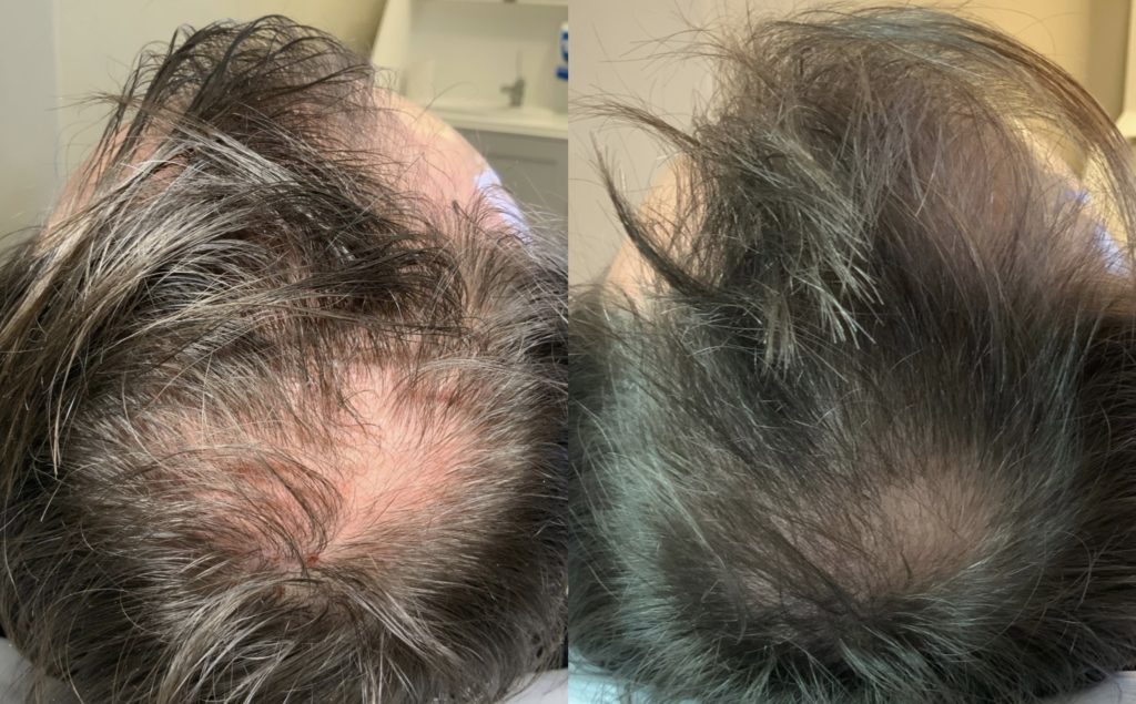 Exosomes for hair loss results
