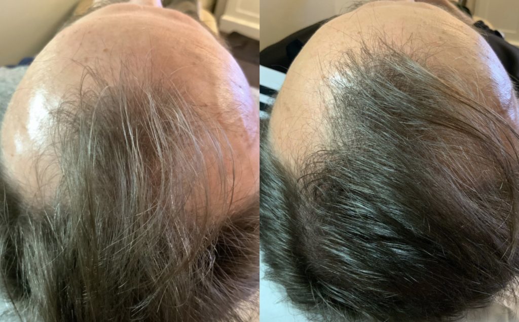 Exosomes for hair loss results